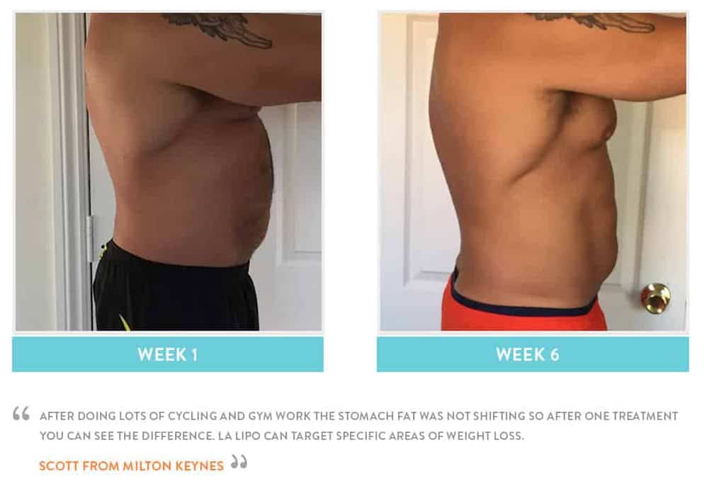 Before & After Stomach Fat West Hampstead