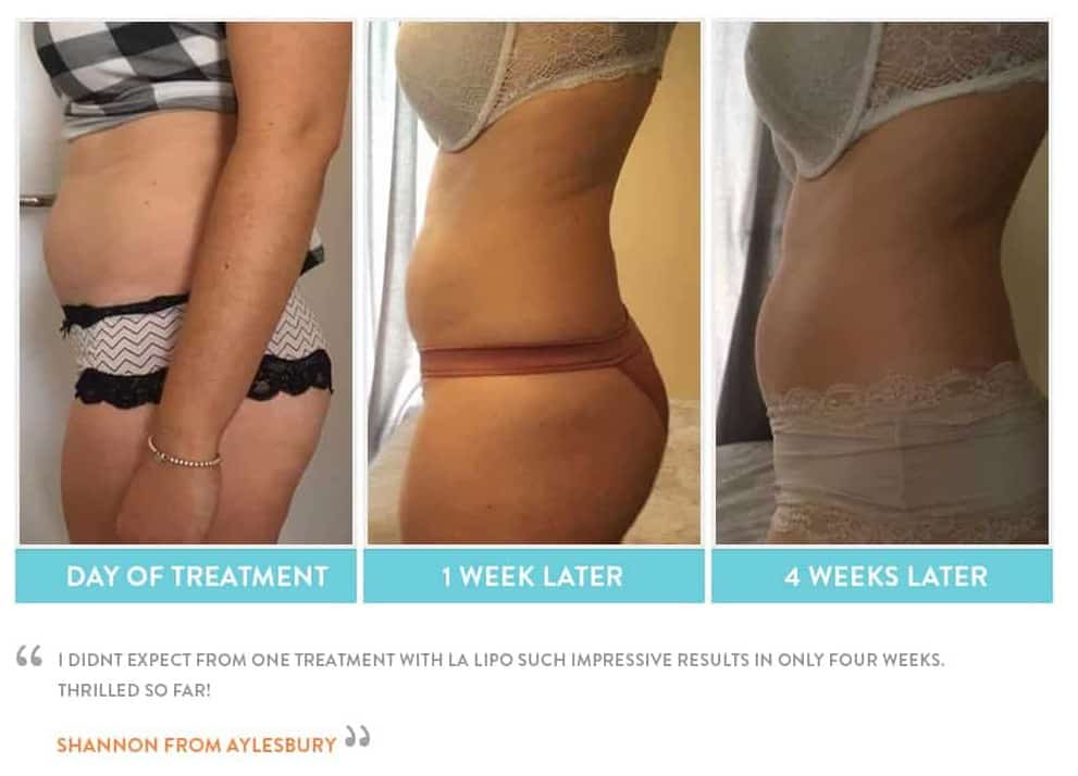 before, Cryolipolysis West Hampstead