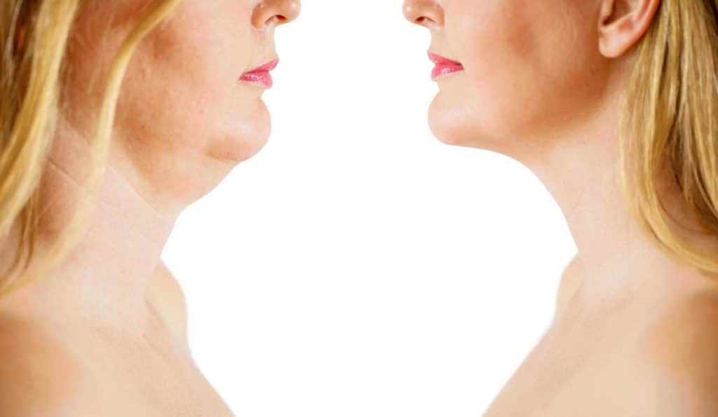 Double Chin treatment West Hampstead before and after results