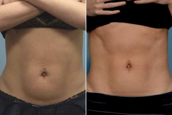 body sculpting FAQs West Hampstead