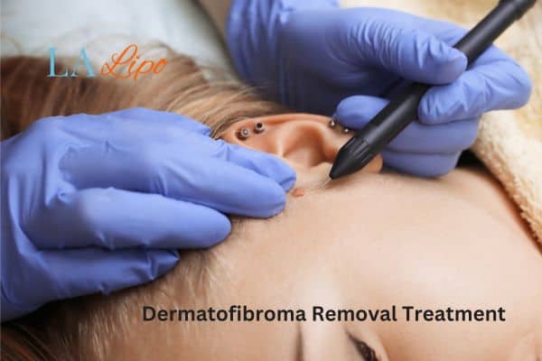 Dermatofibroma Removal Treatment West Hampstead