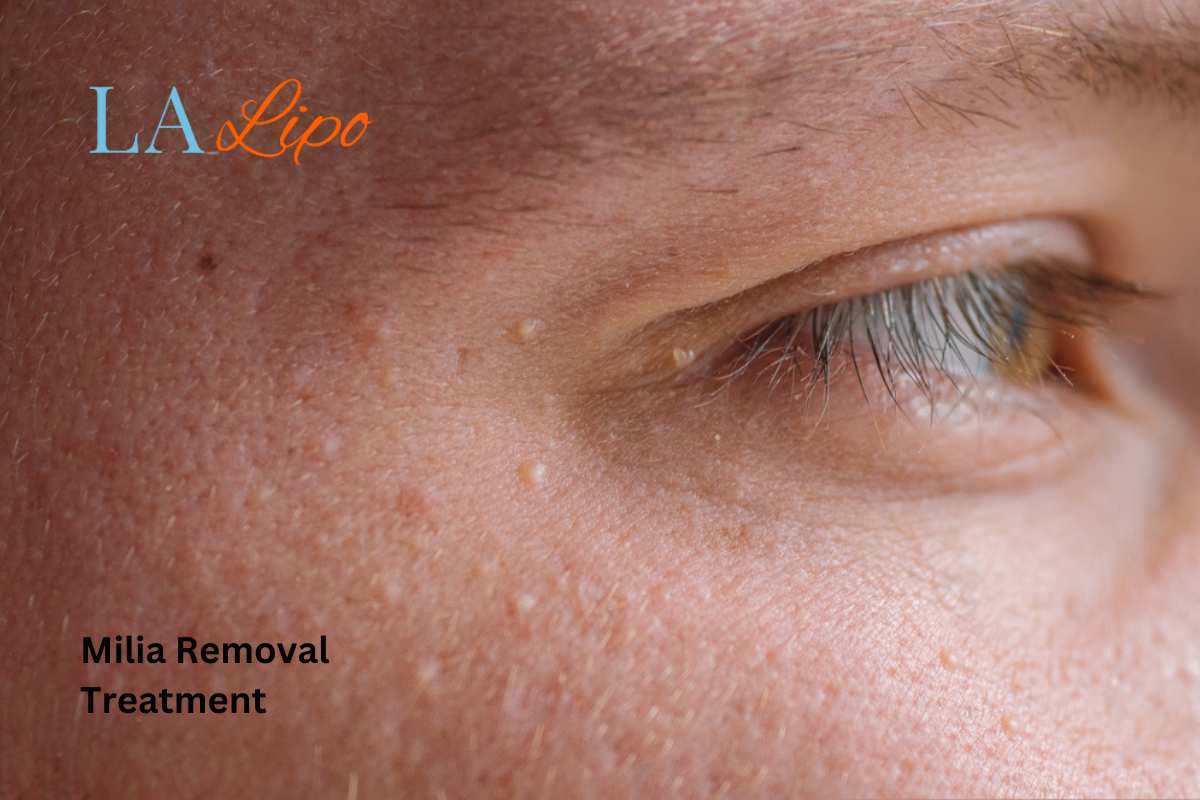 Cryopen Milia Removal: Is It the Easiest and Safest Option West Hampstead?