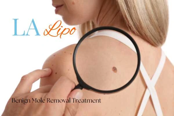 Woman having her inspection of blemish before mole removal West Hampstead