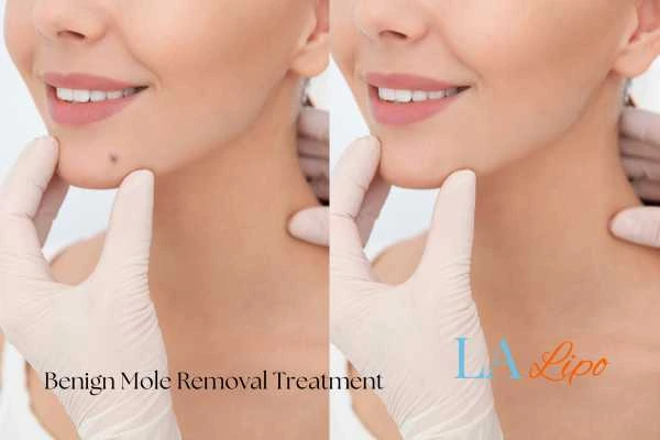 woman's before and after mole removal West Hampstead results