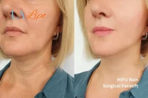 hi-fu for wrinkles West Hampstead before and after results