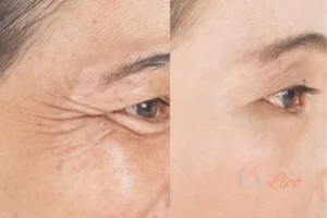 Before and after results of woman - HI-fu wrinkles reduction treatment West Hampstead