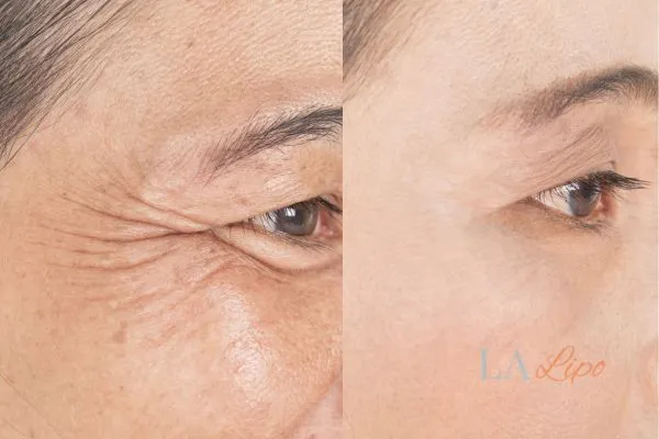 Before and after results of woman - HI-fu wrinkles reduction treatment West Hampstead