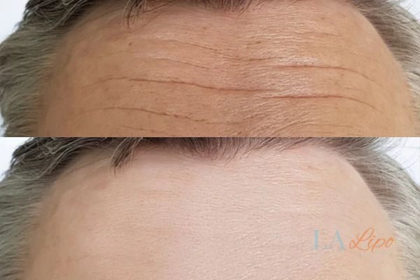 results of HIFU West Hampstead on mans forehead to help reduce lines and wrinkles