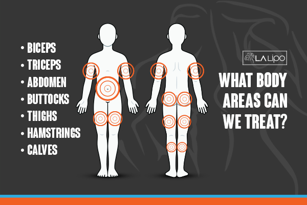 Graphic to show areas you can have LA-EMS Body Sculpting West Hampstead treatment.