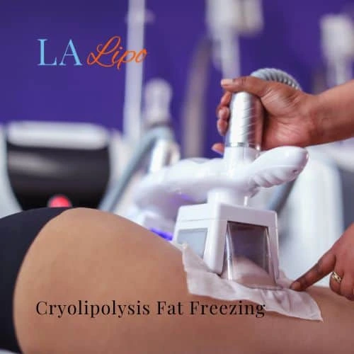 fat freezing - Cryolipolysis West Hampstead