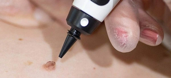 skin tag removal using cryopen West Hampstead