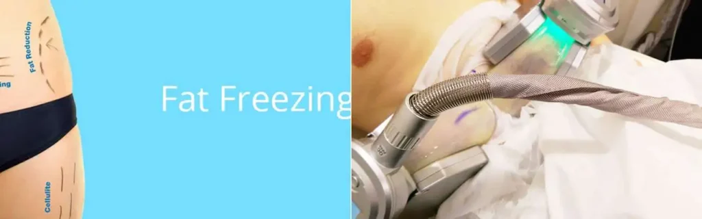 multi areas of a persons body having coolsculpting West Hampstead treatment