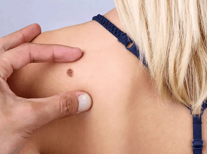 woman having mole removal West Hampstead consultation before treatment.