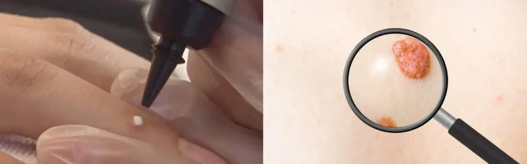 Cryopen for mole removal West Hampstead - speak to our team today!