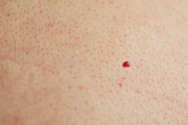 close up of a cherry angioma West Hampstead