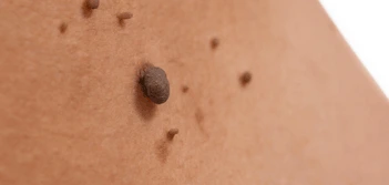 image of a skin tag West Hampstead
