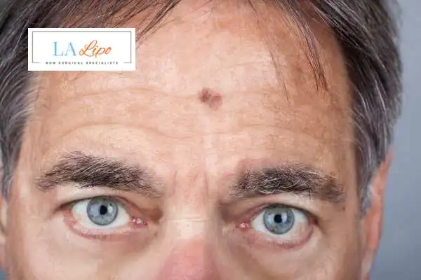 Solar Lentigo Removal West Hampstead image of man with mark on his forehead