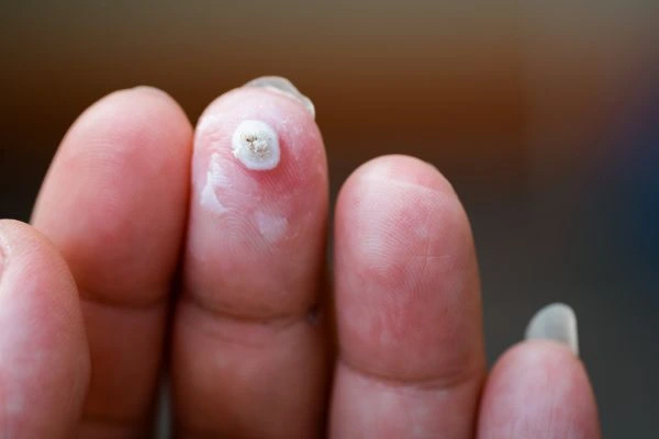 wart on person finger - cryotherapy to treat from LA LIPO West Hampstead