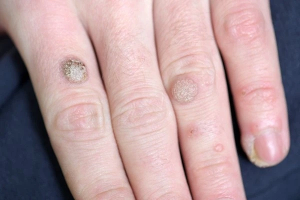 photo of warts on person hand - see wart removal West Hampstead from LA LIPO