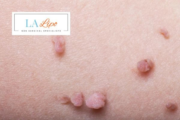 Does cryopen skin tag removal West Hampstead hurt? Find out now call our team today!