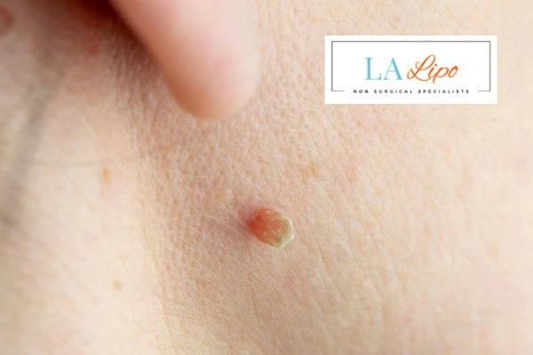 Book skin tag removal West Hampstead today speak to our team now!