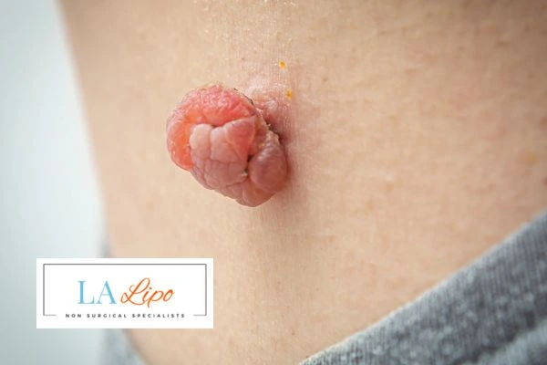 Interested in skin tag removal West Hampstead? Concerned about the pain? Find out more today!