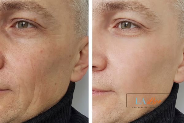 See the amazing results of Morpheus8 Treatment West Hampstead!