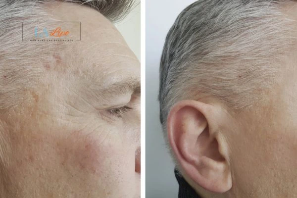 Mens Before & After Morpheus 8 Results West Hampstead