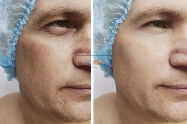 Before and after Morpheus 8 Results West Hampstead