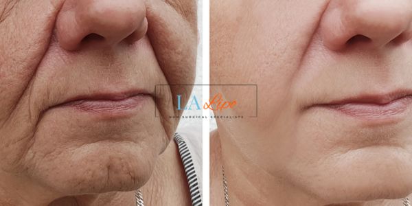 Older lady deeper wrinkle reduction - LA LIPO Morpheus 8 Results West Hampstead