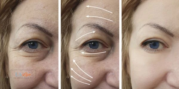Amazing eye lift Morpheus 8 results West Hampstead