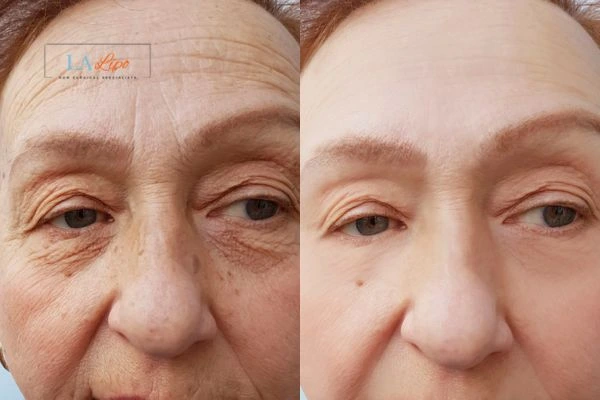 The powerful benefits of Morpheus8 Treatment West Hampstead - Call Our team today!