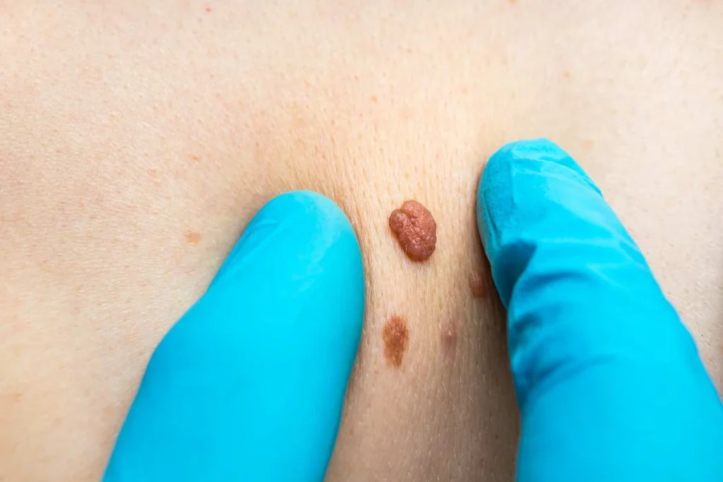 LA LIPO Cryopen Lesion Removal Prices West Hampstead