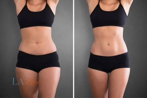before and after results of non-surgical treatment to help a woman's body image and mental health West Hampstead