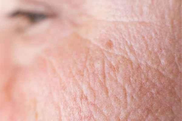 close up picture of a woman's face showing an age spot West Hampstead