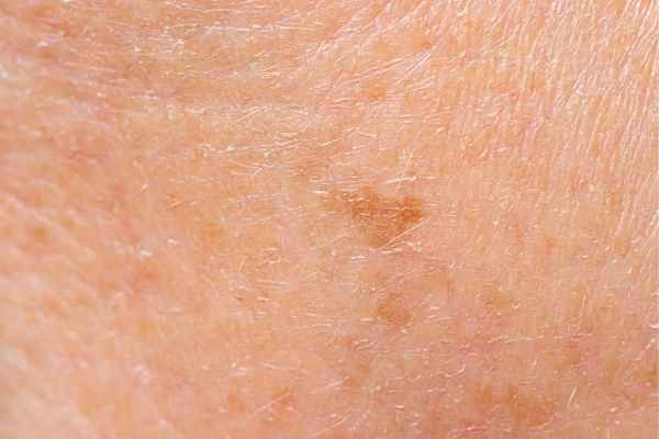 close up picture of age spots West Hampstead