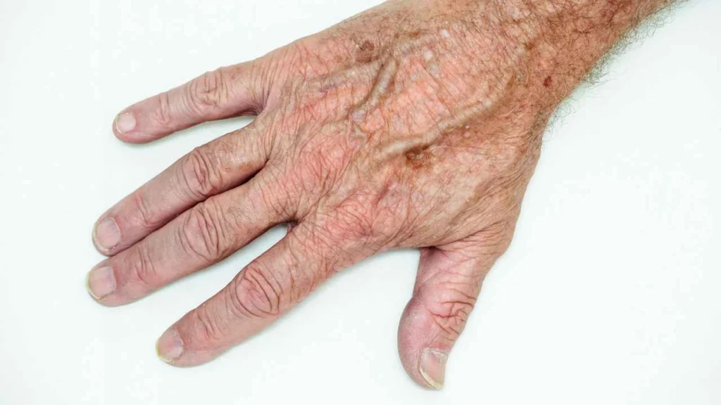 Male hand showing age spot West Hampstead