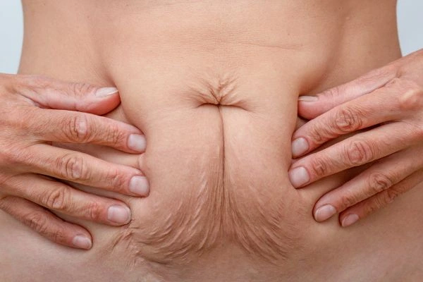Image of a woman's stomach with loose skin - example of skin tightening West Hampstead options