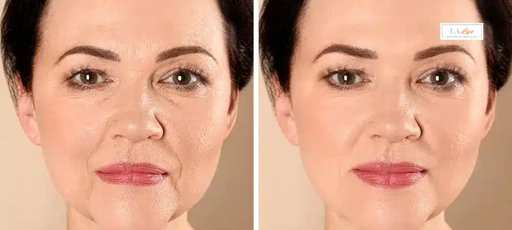 How Long Does It Take to See Results and How Long Do They Last West Hampstead?